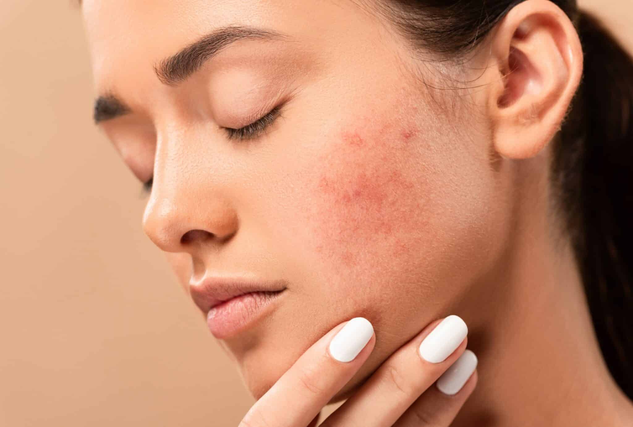 Rosacée les traitements Dr Tribout Dermatologie esthétique Amiens