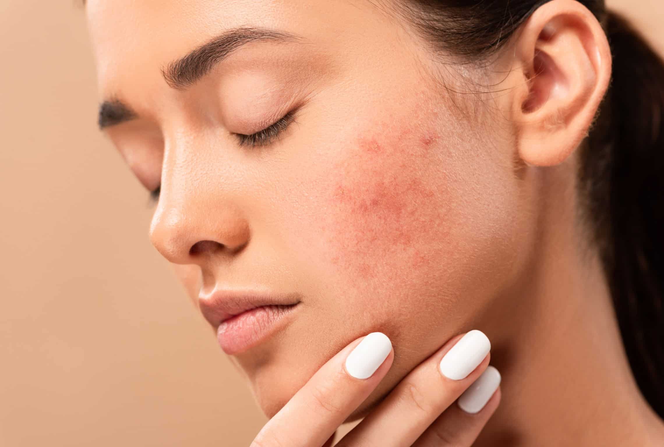 Rosacée : les traitements | rosacée visage, acné rosacée | Dermatologie esthétique lasers | Amiens