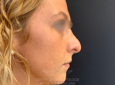 Photo avant | Acide hyaluronique levres | Dr Tribout | Amiens