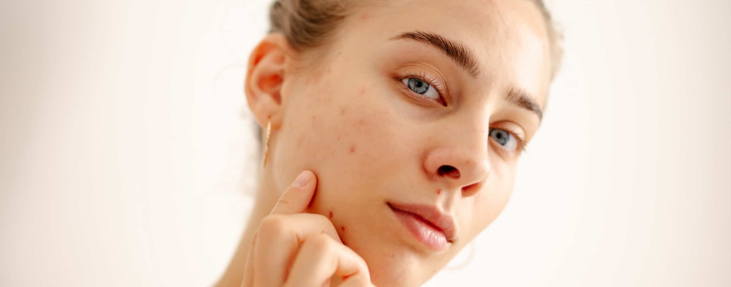 Traitements des imperfections cutanées