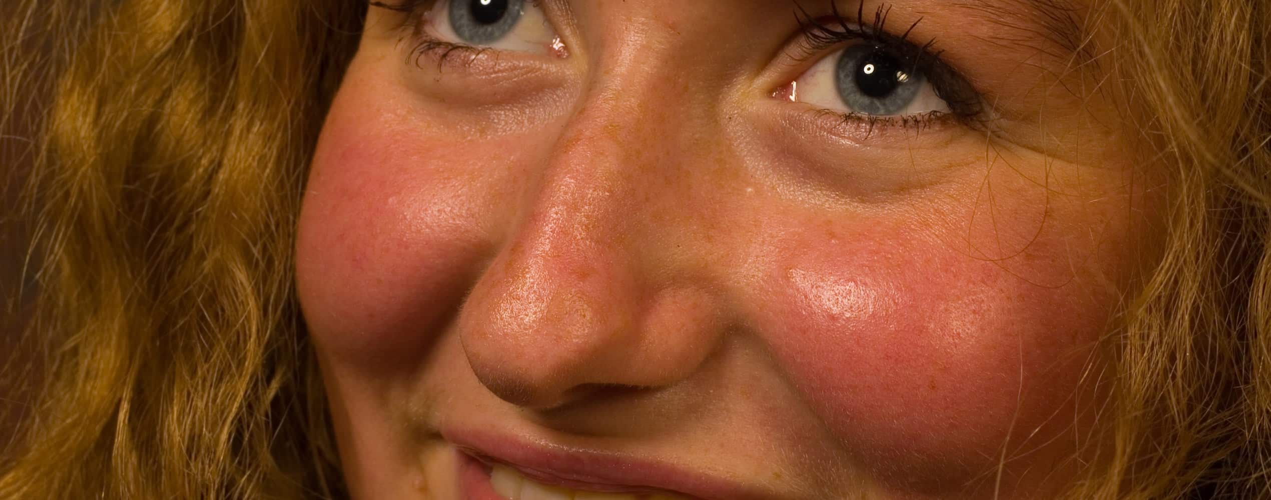 Taches brunes et couperose