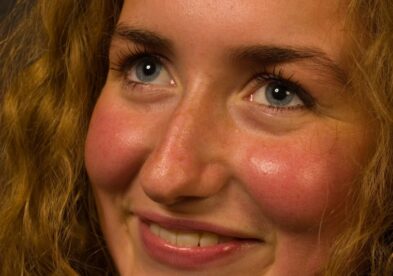 Taches brunes et couperose