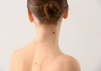 Grains de beauté | Dr Tribout | Amiens